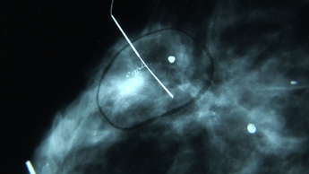 Mammogram wire